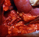 Kidney Transplantation surgery
                                    