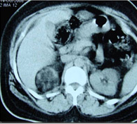 Right Adrenal Tumor, Urologic Oncology