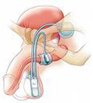 Post-prostatectomy Incontinence